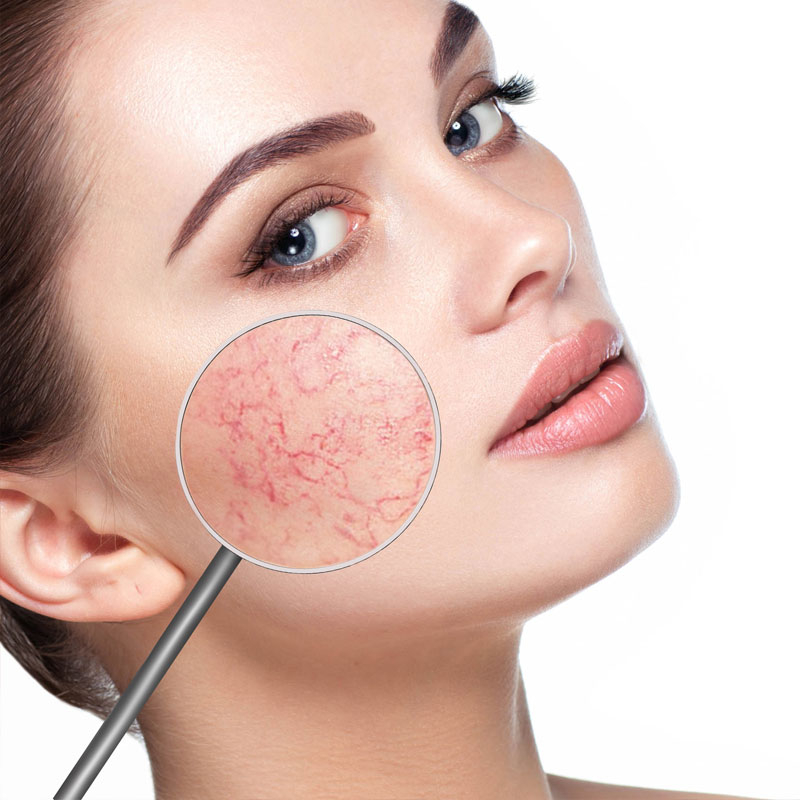 ▿ W Klinice Miracki Warszawa, Katowice, Kraków, Łódź dysponujemy aż 3 laserami Cutera Excel V, Cutera Excel V+ oraz Alma Harmony Dye-VL, które uwolnią Cię od pękających naczynek, sprawdź!