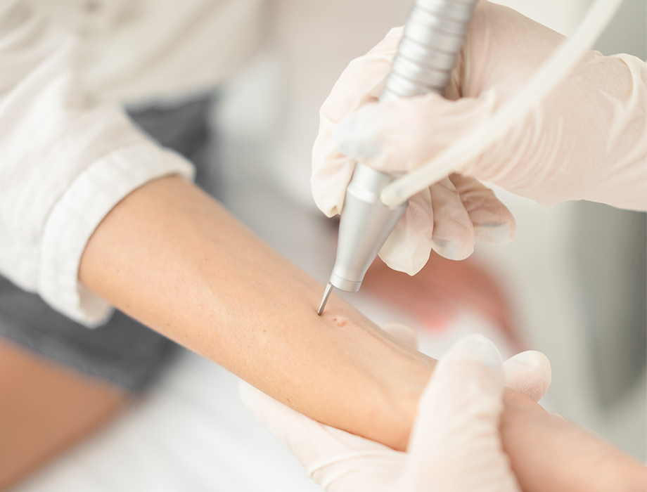 Nasi doświadczeni Specjaliści wykonują zabiegi Laserowego Usuwania Zmian Skórnych, dzięki którym możesz pozbyć się pieprzyków, włókniaków i brodawek!