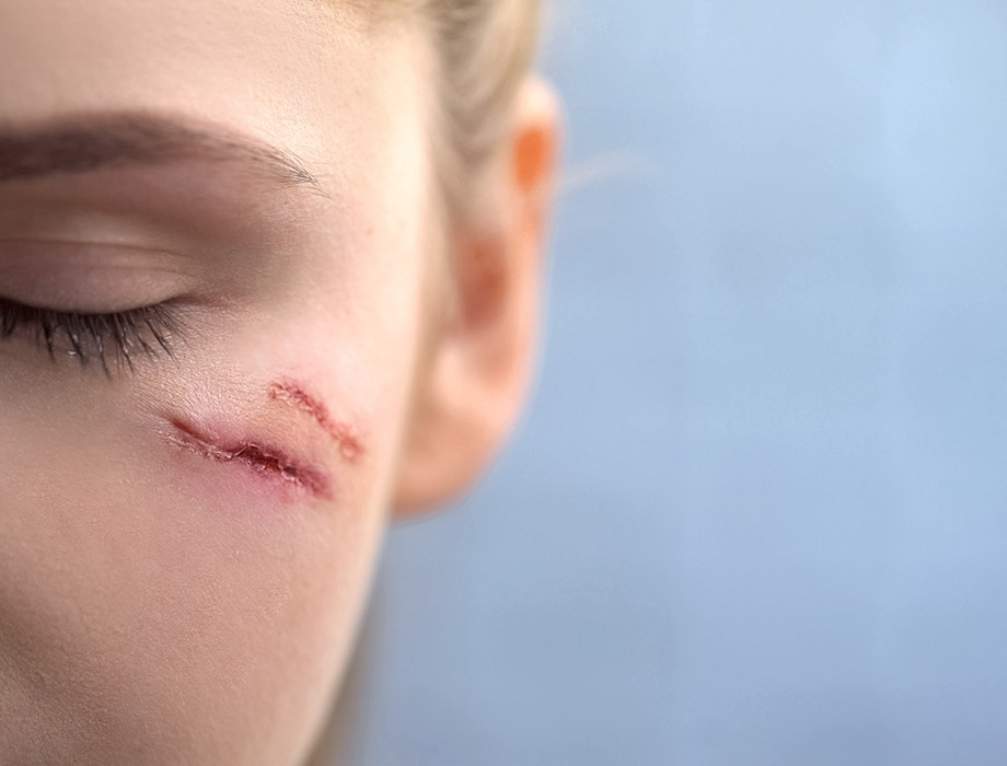 Blizna cięta na twarzy to poważny problem estetyczny. Jak się jej pozbyć? ✹ Sprawdź, jaką metodę usuwania blizn proponują eksperci z kliniki w Katowicach, Krakowie, Warszawie i Łodzi.