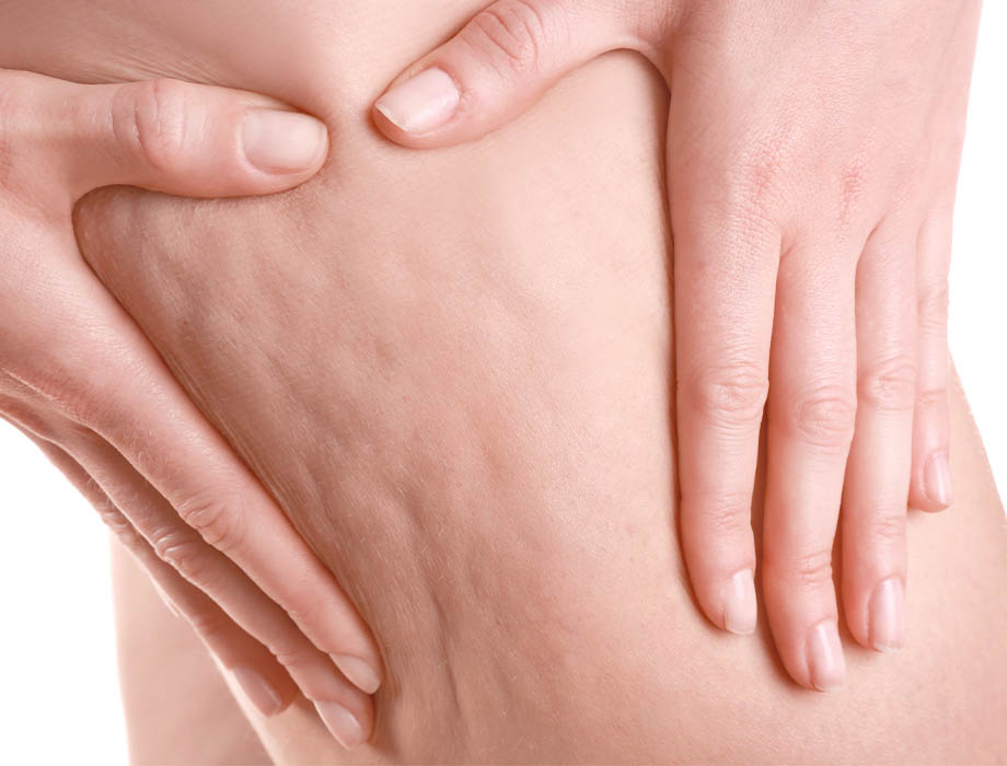 Jak wymodelować ciało, by pozbyć się bryczesów na udach i cellulitu? ✹ Weź udział w Akcji Ciało 2022 w Warszawie lub Katowicach i skorzystaj ze skutecznych zabiegów.