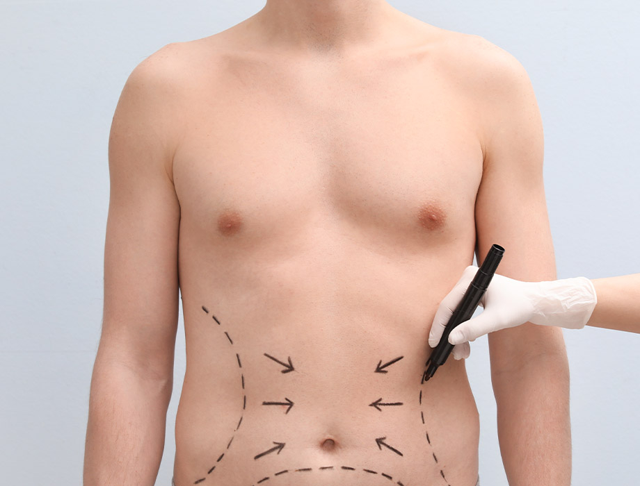 Miejscowa otyłość u mężczyzn pojawia się w okolicach brzucha, ale też na szyi czy plecach. ✹ Zobacz, jak radzi sobie z tym zabieg liposukcji w Klinice Miracki w Warszawie lub Katowicach. Zapraszamy też do naszych klinik w Łodzi i Krakowie.