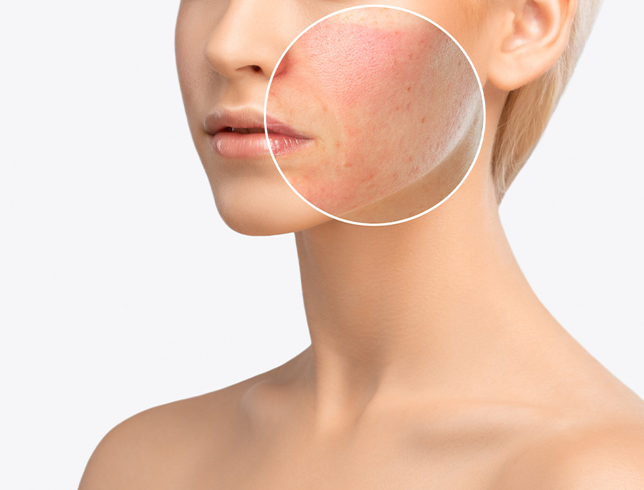 Chcesz usunąć naczynka, rumień i przebarwienia na twarzy? Umów się laserowe leczenie tych zmian w warszawskiej Klinice Miracki. Zapraszamy na zabiegi w naszych klinikach w Warszawie, Łodzi, Katowicach i Krakowie.