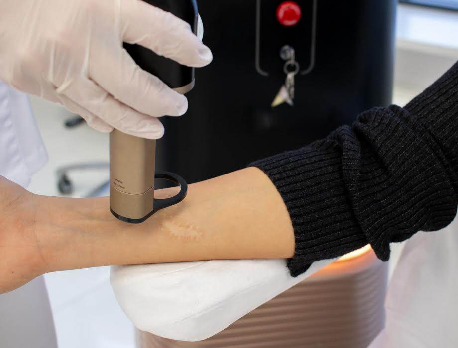 Blizny to zmiany skórne, których nie sposób pozbyć się domowymi sposobami. Sprawdź, jak usunąć blizny po samookaleczeniu w naszej klinice w Warszawie.