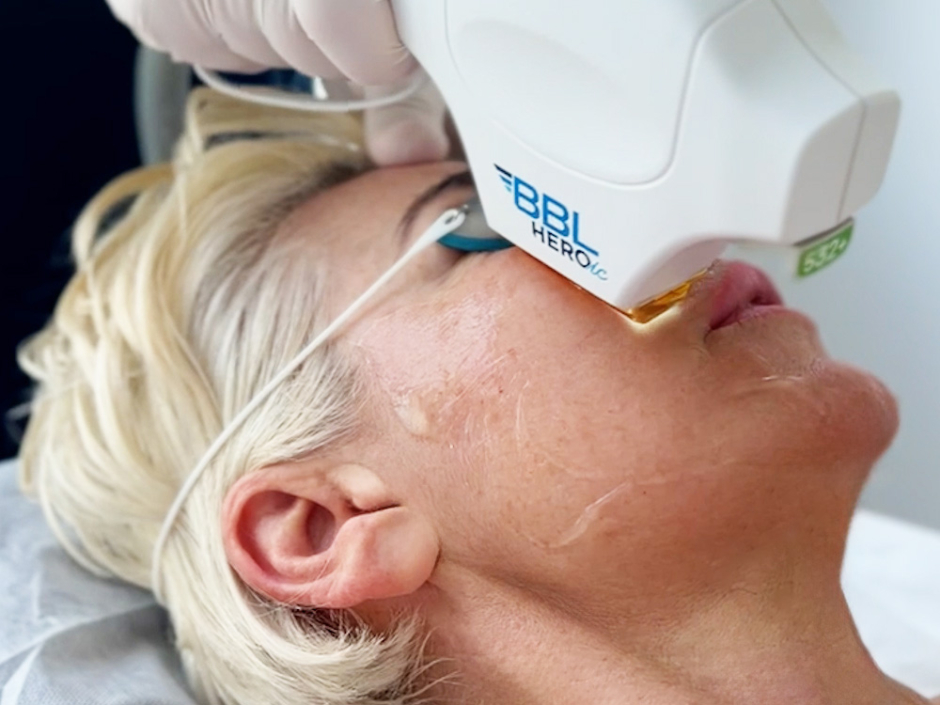 Terapia światłem BBL – nowatorska metoda fotoodmładzania, która wpływa na geny odpowiedzialne za procesy starzenia skóry. Kompleksowa rewitalizacja: napięcie, koloryt, redukcja przebarwień.