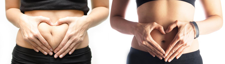 Osiągnij wymarzoną sylwetkę dzięki liposukcji lub lipotransferowi. ➙ W Klinice Miracki w Warszawie, Krakowie, Łodzi i Katowicach znajdziemy idealny zabieg modelujący sylwetkę dla Ciebie!