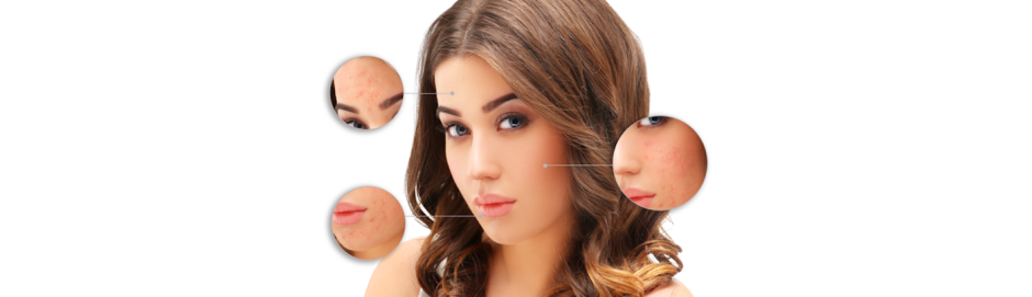 Poznaj 5 największych mitów dotyczących leczenia trądziku i zobacz, czego się wystrzegać. Dowiedz się, jak powinna wyglądać pielęgnacja skóry trądzikowej! ➡ Klinika Miracki Warszawa, Katowice, Kraków, Łódź.