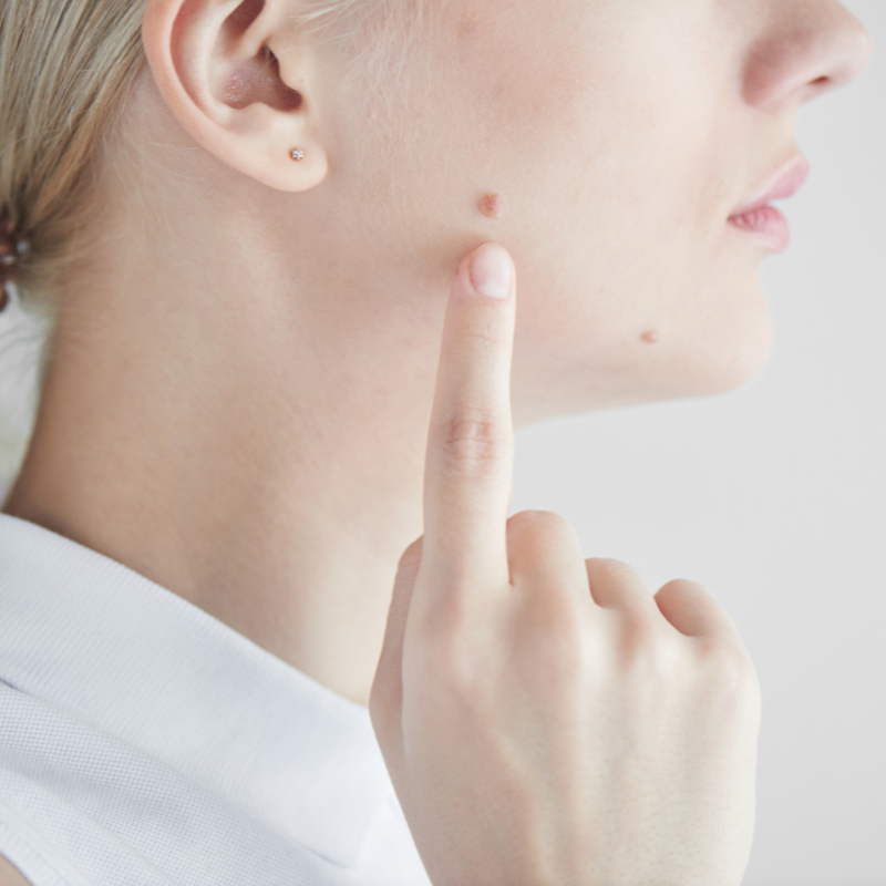 Eksperci z Kliniki Miracki Warszawa, Katowice, Kraków, Łódź. podają 10 powodów, dla których należy badać znamiona skórne jesienią. ➙ Dowiedz się więcej!