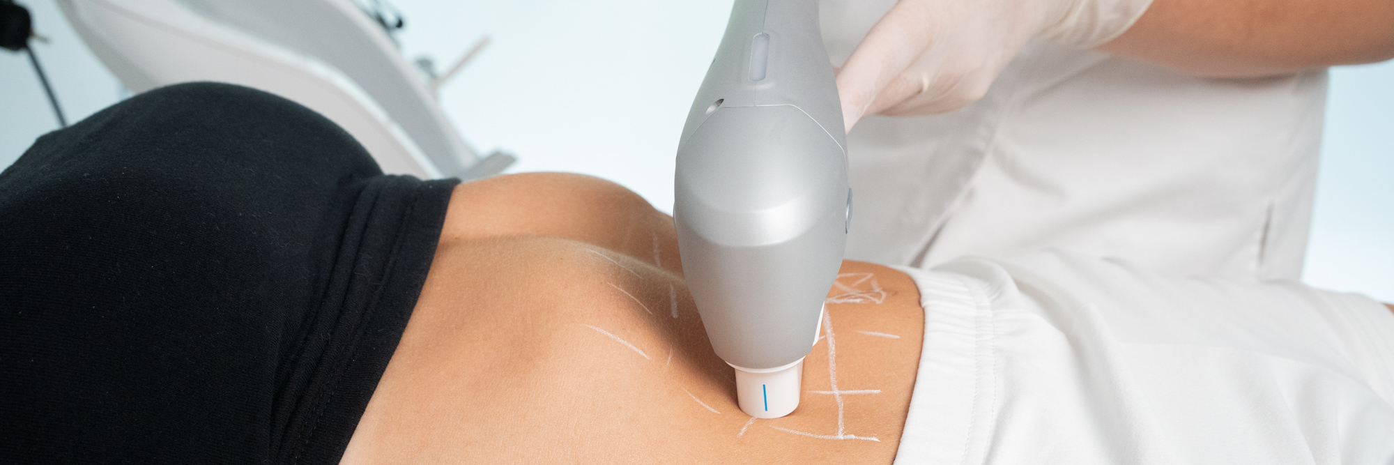 HIFU – Lifting bez skalpela HIFU – Lifting bez skalpela