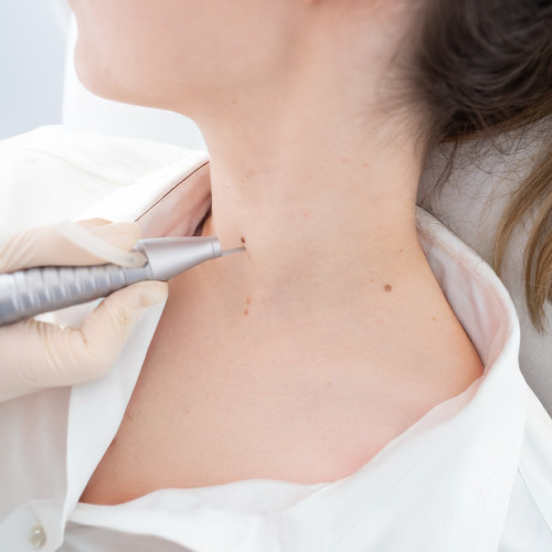 CO2 Metrum Cryoflex – Laserowe usuwanie zmian skórnych