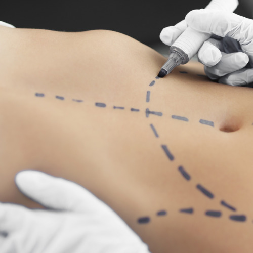 Miniabdominoplastyka