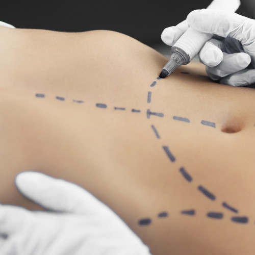 Abdominoplastyka