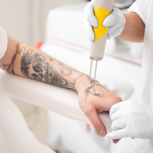 Discovery Pico Plus Quanta – Laserowe usuwanie tatuażu i makijażu permanentnego