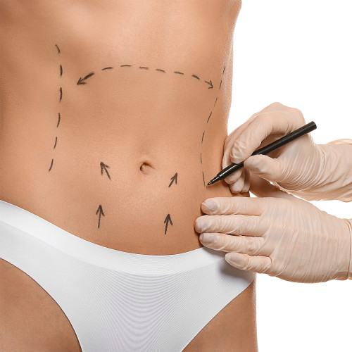 Liposukcja brzucha z abdominoplastyką