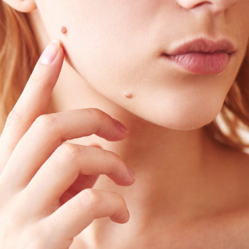 Chirurgiczne usuwanie zmian skórnych