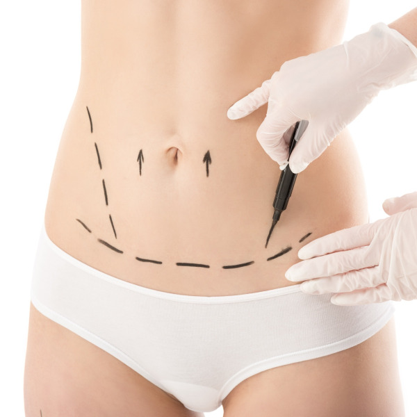 Liposukcja brzucha z miniabdominoplastyką