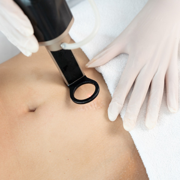 Hybrid Alma – Laserowe usuwanie blizn i rozstępów