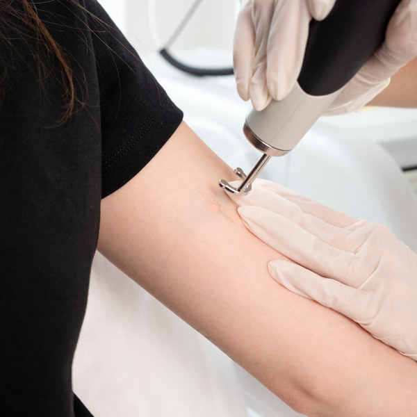 Discovery Pico Quanta – Laserowe usuwanie blizn i rozstępów