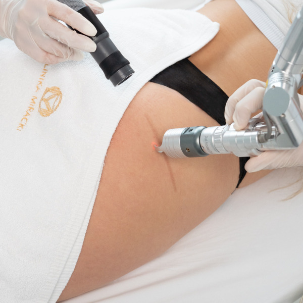 Pico Plus Lutronic – Laserowe usuwanie blizn i rozstępów