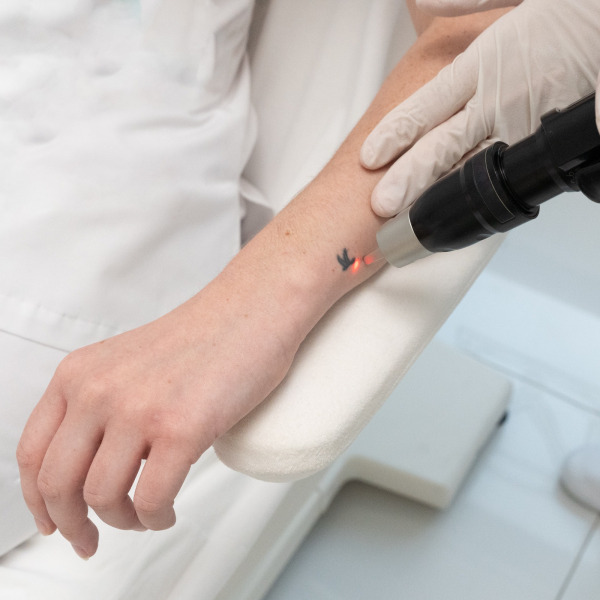 PicoSure Cynosure – Laserowe usuwanie tatuażu i makijażu permanentnego