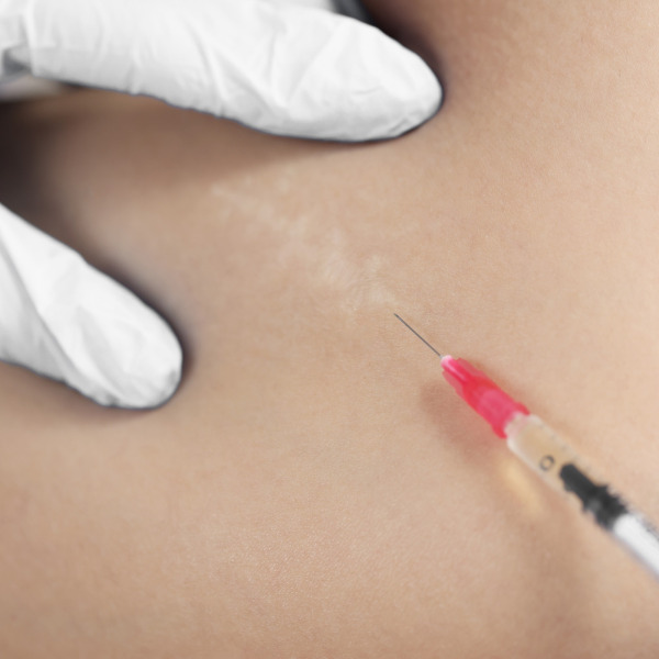 Ostrzyknięcie sterydem blizn