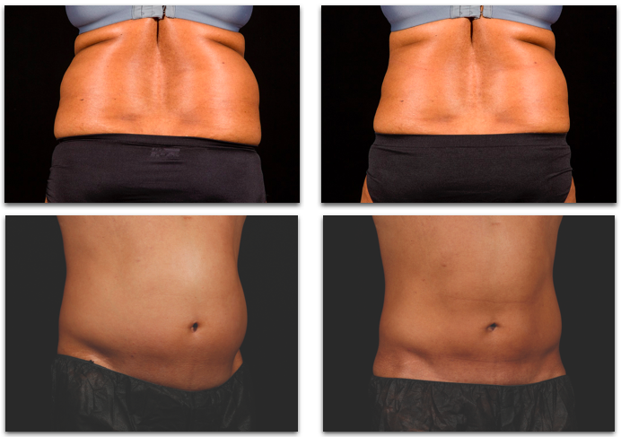 Efekty wyszczuplania ciała laserem Sculpsure