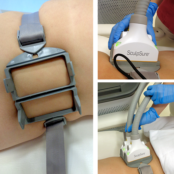 Przygotowanie do zabiegu laserowego wyszczuplania Sculpsure