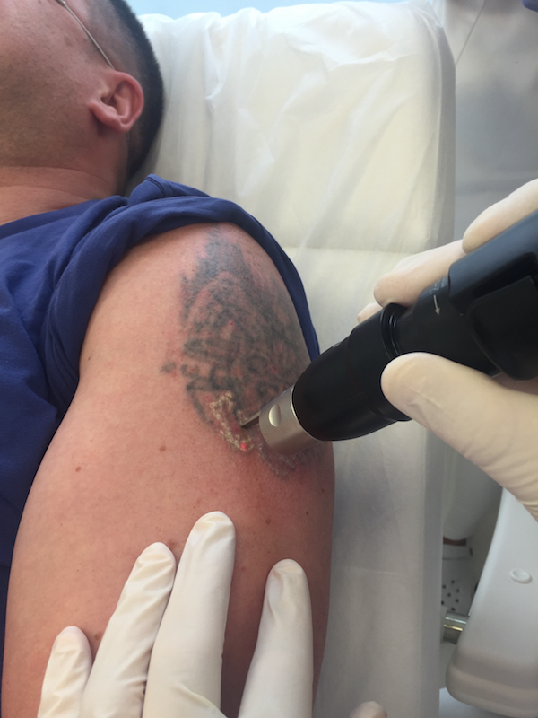 usuwanie tatuażu, laserowe usuwanie tatuażu, usunięcie tatuażu, jak usunąć tatuaż, laser picosure, laser picosekundowy