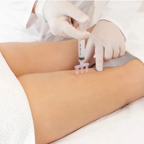 Mezoterapia Igłowa – ALIDYA