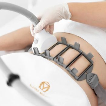 Laser SculpSure