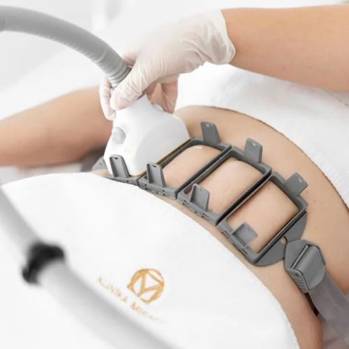 Sculpsure – Redukcja tkanki tłuszczowej – 1 zabieg