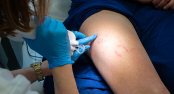Jak pielęgnować skórę po zamykaniu naczynek metodą laserową? Eksperci z warszawskiej kliniki odpowiadają